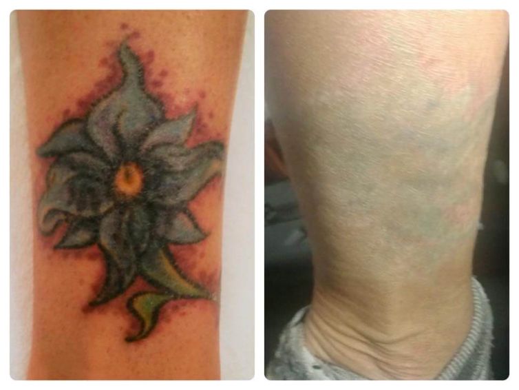 Flower on Ankle Tattoo Removal