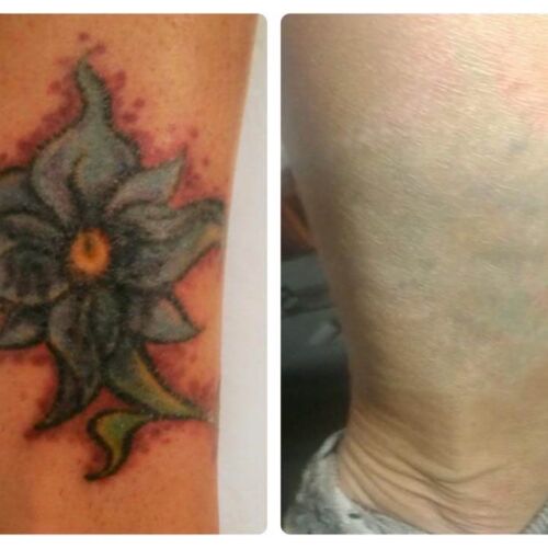 Flower on Ankle Tattoo Removal