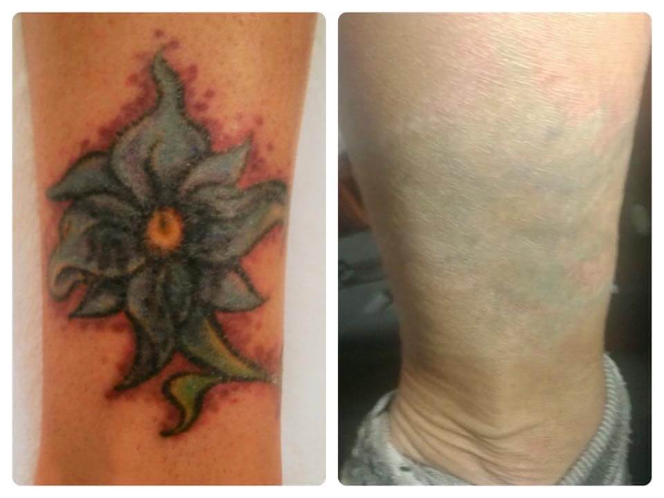 Laser Tattoo Removal Case 36