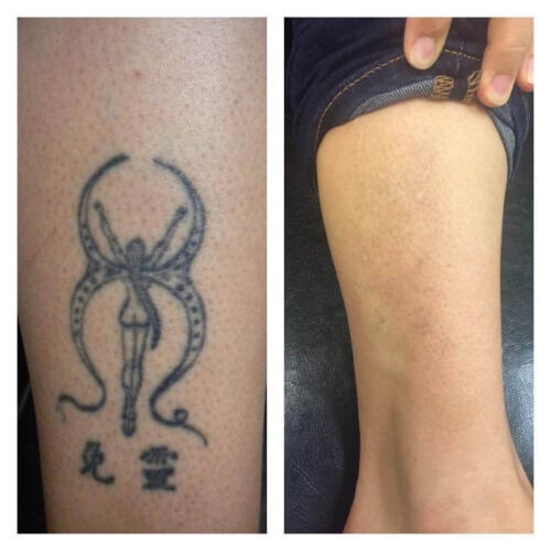 Serpent on Arm Tattoo Removal