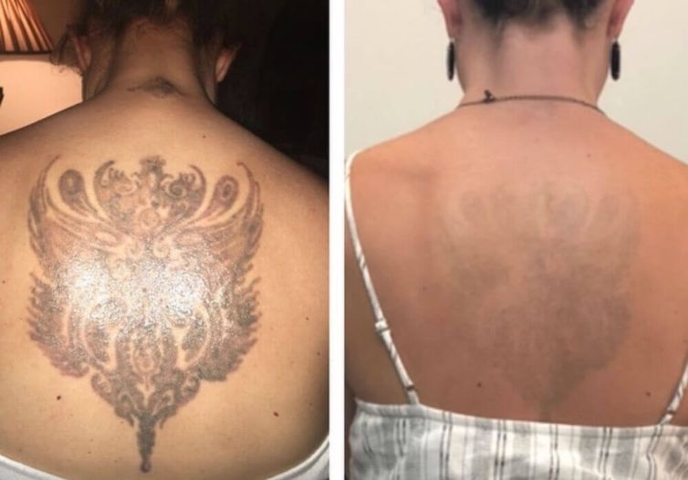 Back Symbol Tattoo Removal