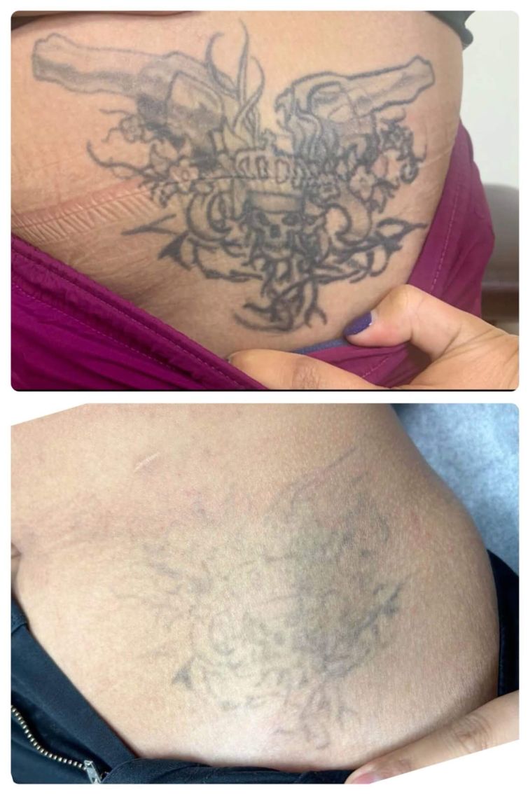 Belly Tattoo Removal on Woman