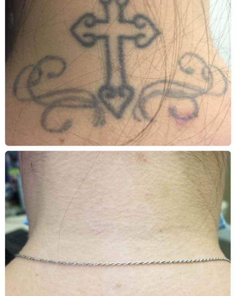 Cross Tattoo Removal
