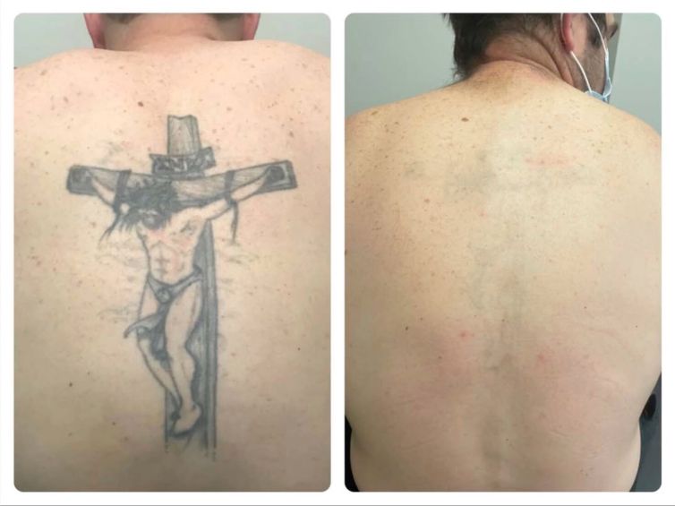 Crucifix Tattoo Removal on Back