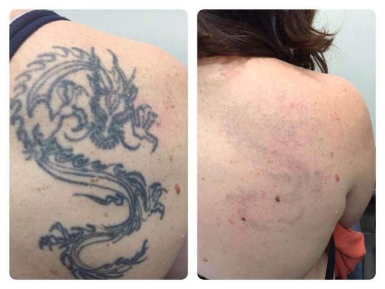 Dragon Tattoo Removal on Woman’s Shoulder