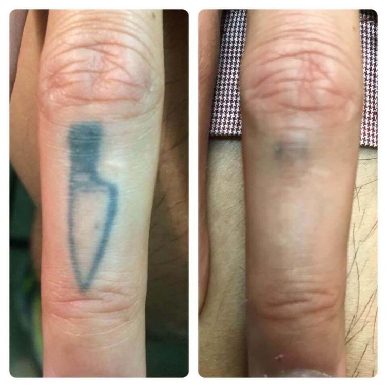 Tattoo Removal of Knife on Finger