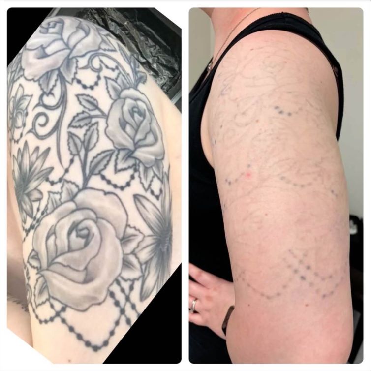 Flower Tattoo Removal on Woman’s Arm