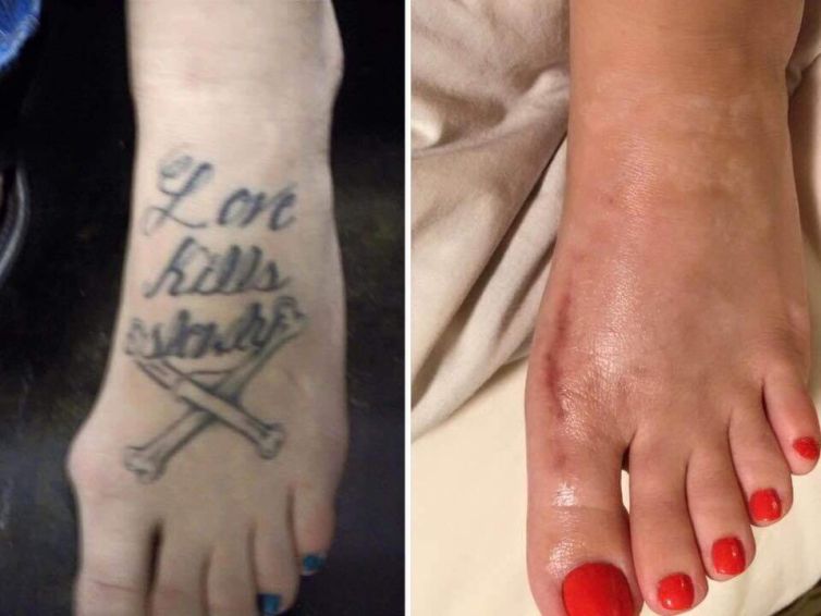 Tattoo Removal on Foot