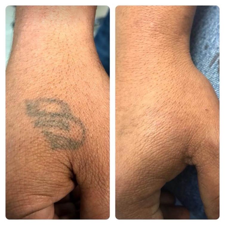 Hand Tattoo Removal