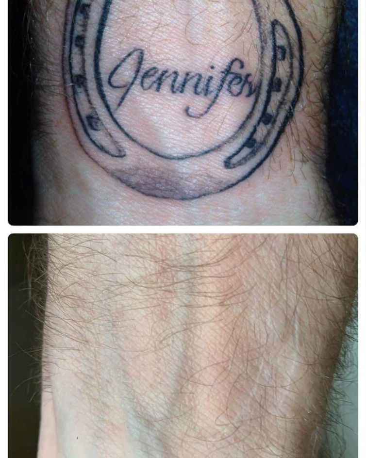 Girlfriend Name Tattoo Removal