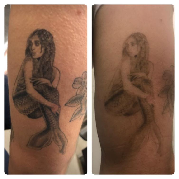 Mermaid Tattoo Removal