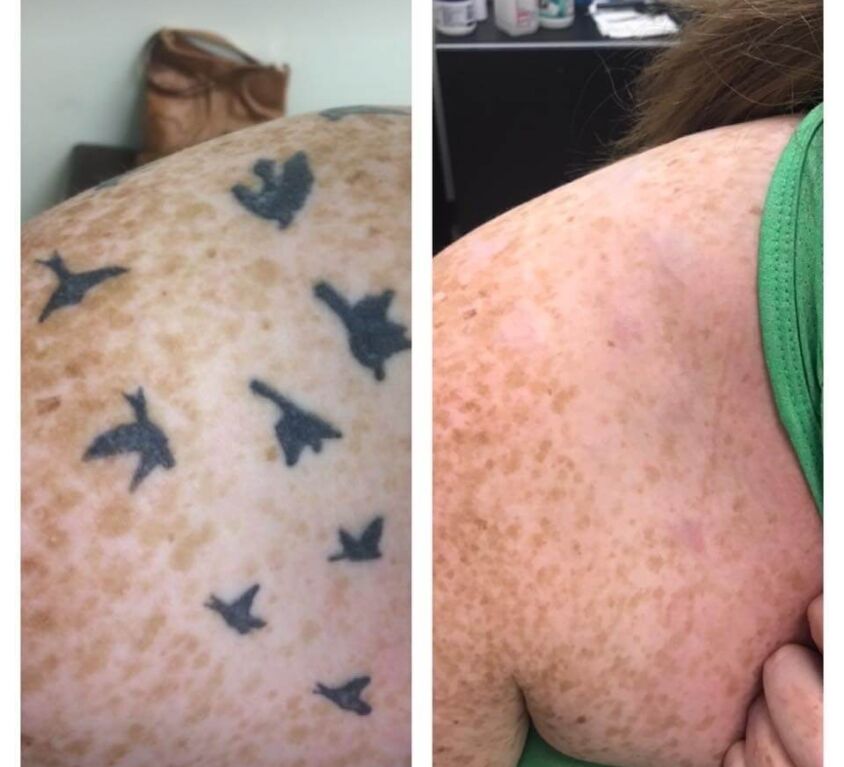 Multiple Tattoo Removal on Shoulder