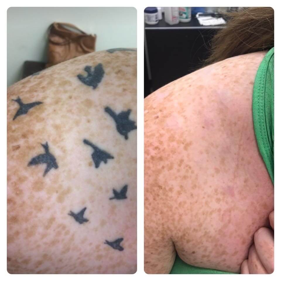 Clean Canvas Laser Tattoo Removal – People Change, Tattoo's Do Not