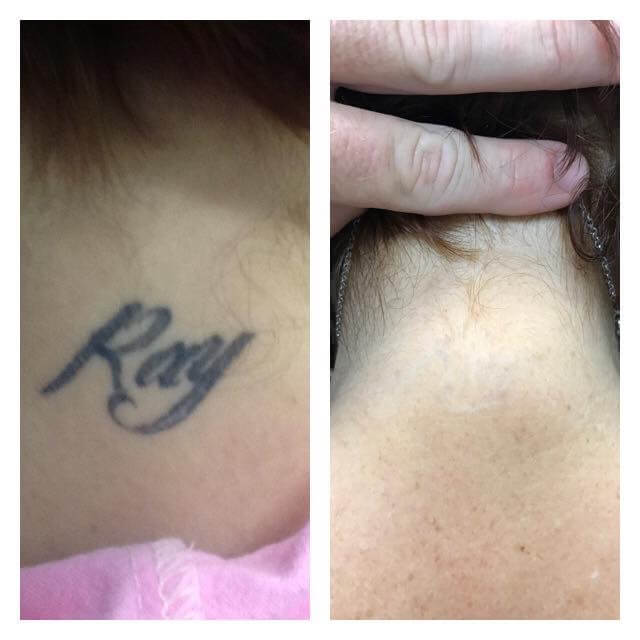 Name Tattoo Removal on Neck