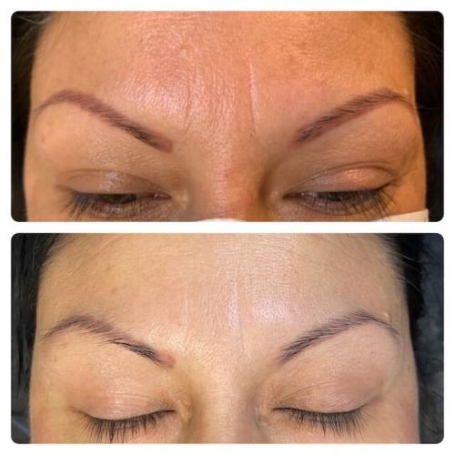 Permanent Makeup Removal on Eyebrows