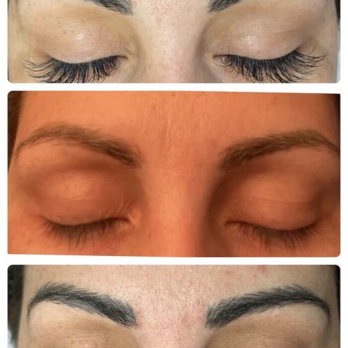 Permanent makeup removal before and after