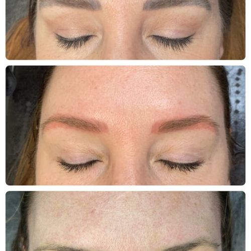 Permanent makeup removal before and after