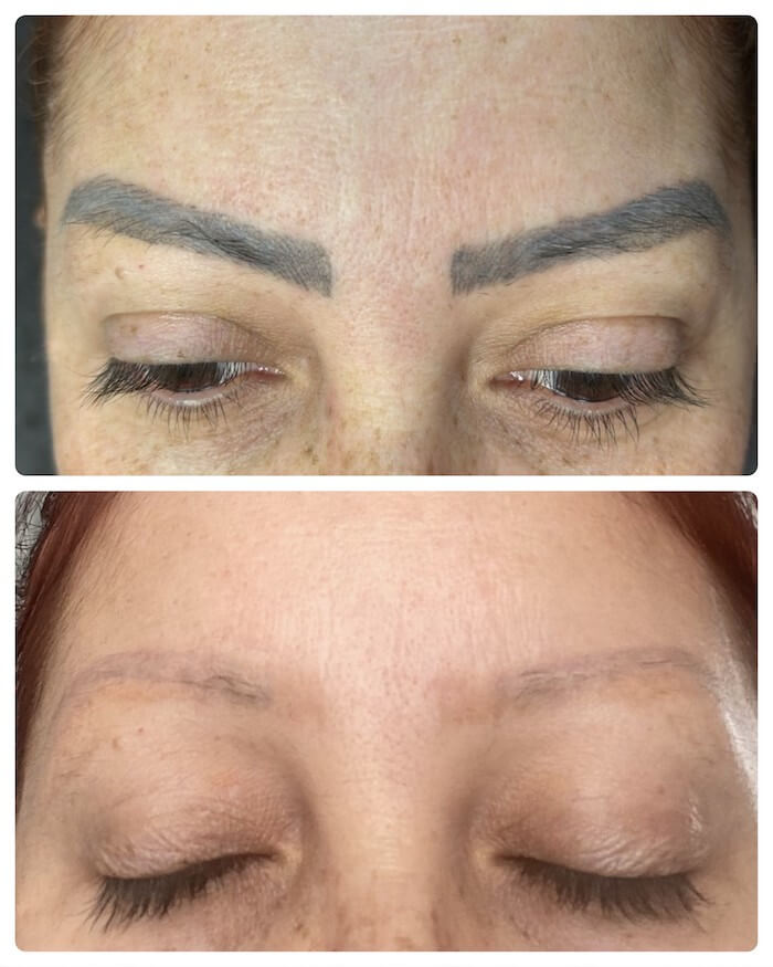 Eyebrow Permanent makeup removal before and after