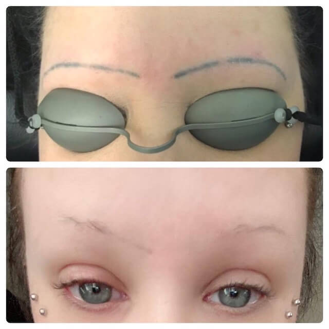 Permanent Makeup Removal Eyebrow