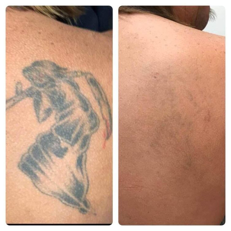 Reaper Tattoo Removal