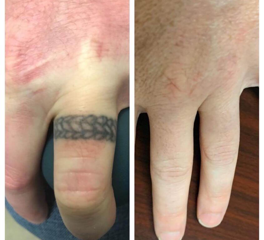 Ring Finger Tattoo Removal