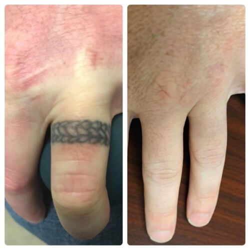 Ring Finger Tattoo Removal
