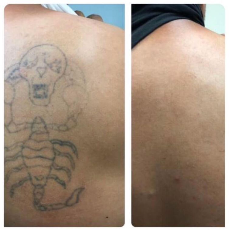 Scorpion Tattoo Removal