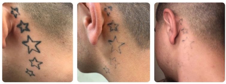 Star Tattoo Removal on Neck