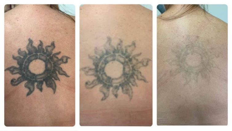 Sun Tattoo Removal