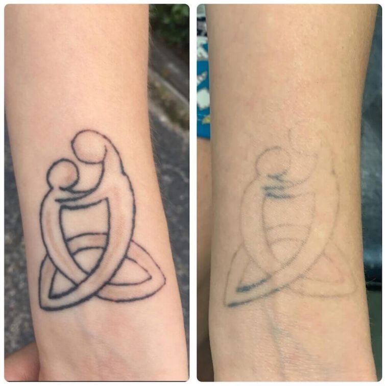 Tattoo Removal of Symbol