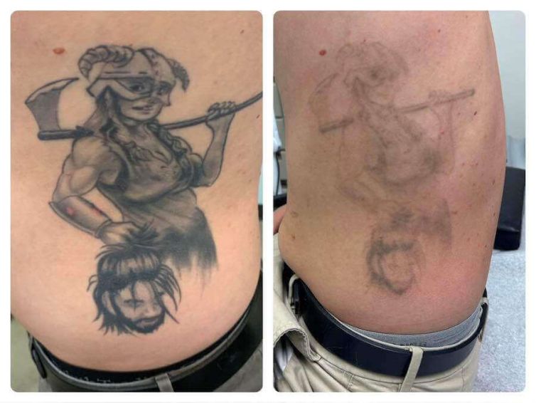 Demon Tattoo Removal Before and After