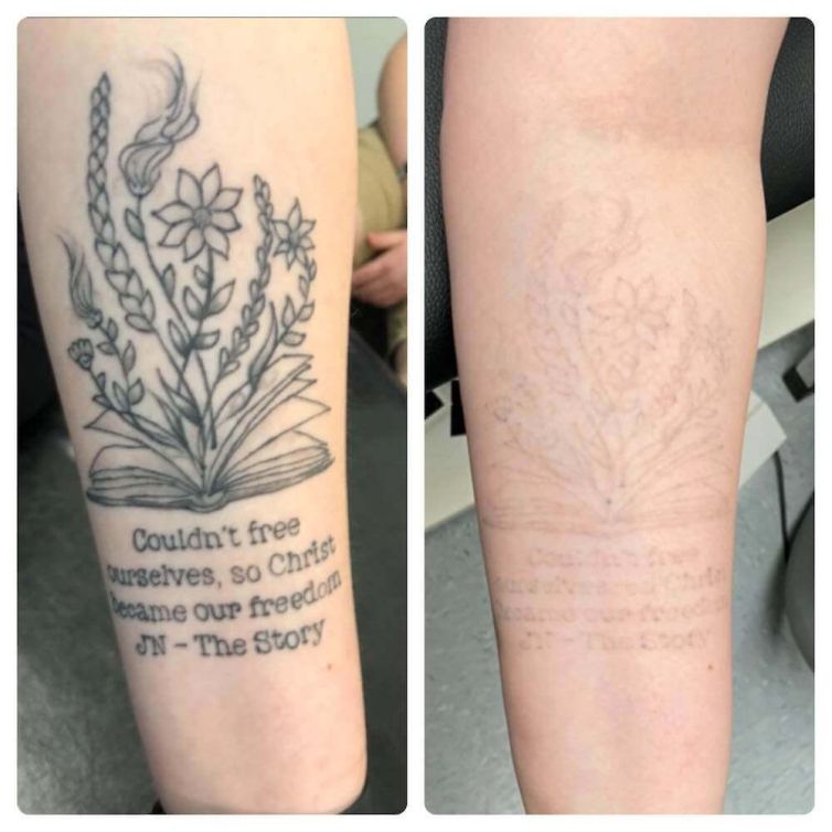 Memorial Tattoo Removal from Arm