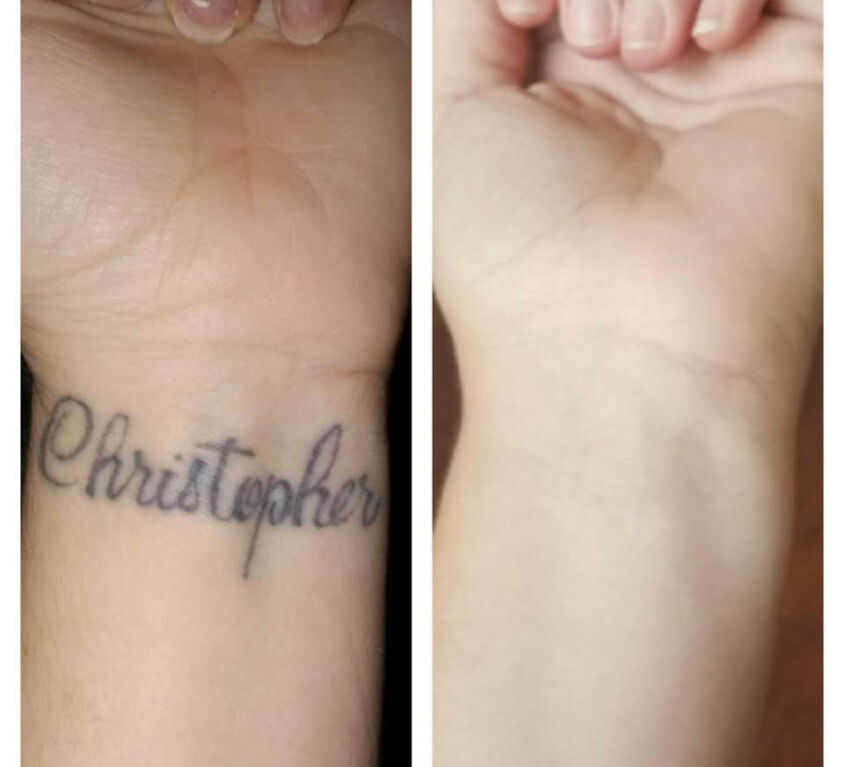 Tattoo Removal Name on Wrist