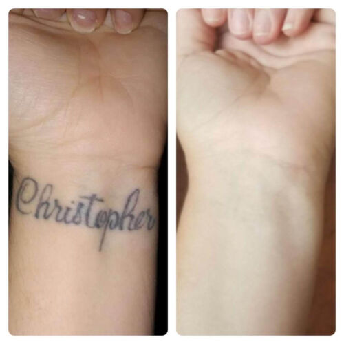 Tattoo Removal Name on Wrist