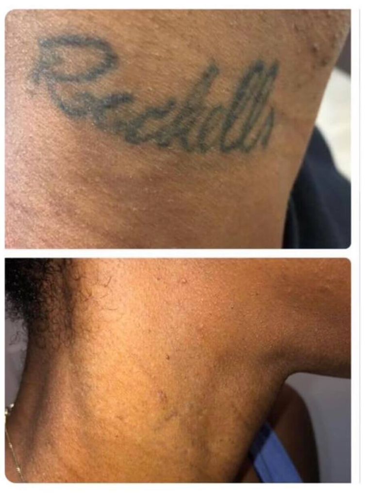 Name Tattoo Removal from Neck
