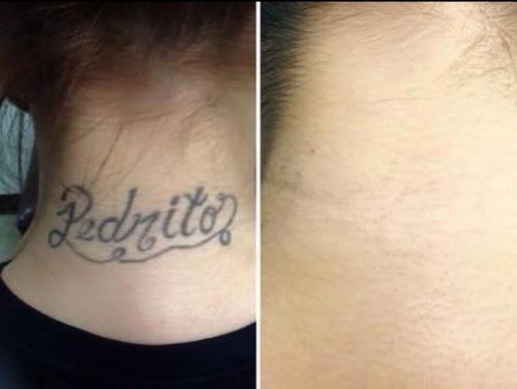 Boyfriend Name Tattoo Removal from Neck