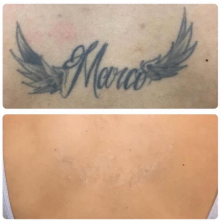 Removal of Tattooed Name from Back