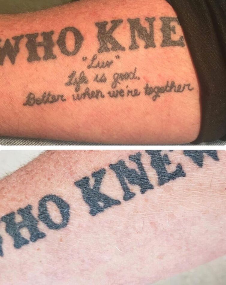 Partial Tattoo Removal