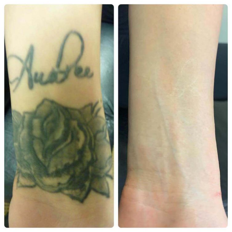 Rose Tattoo Removal on Arm