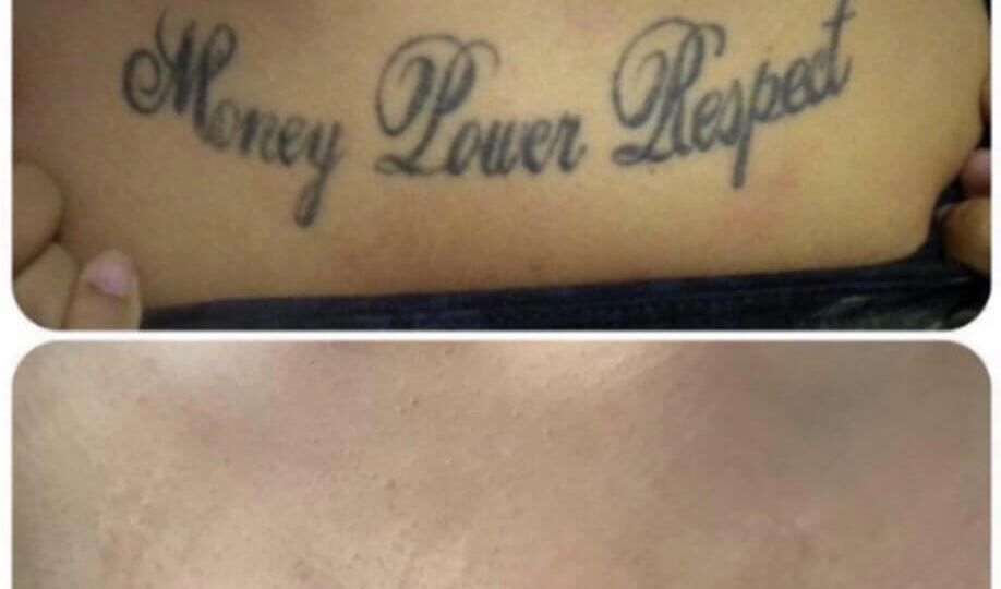 tattoo-removal-script