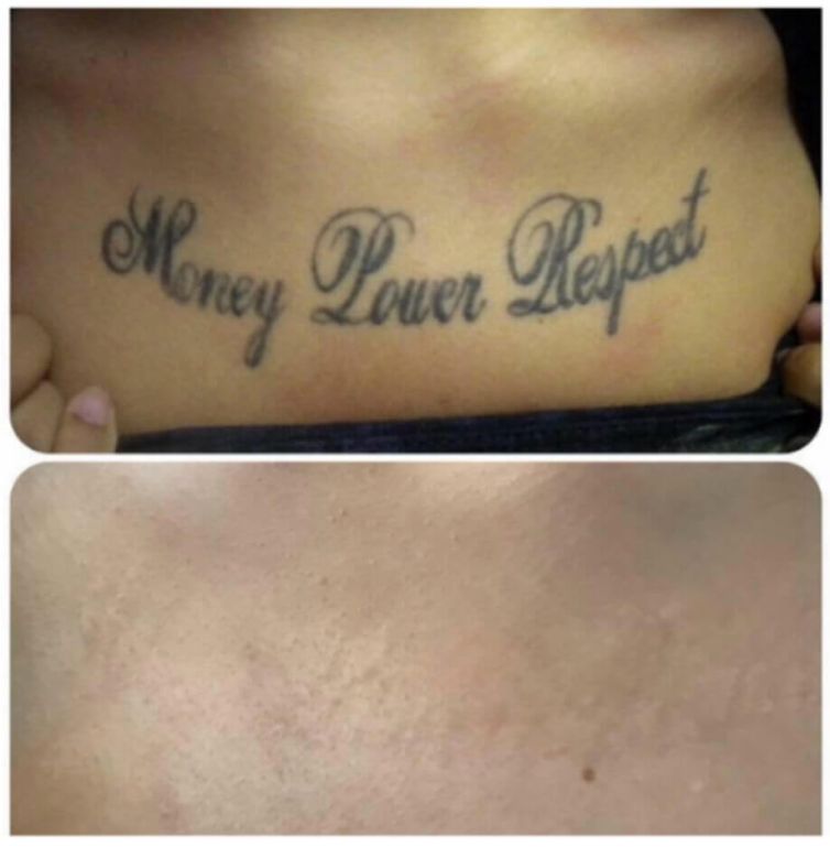 Belly Tattoo Removal