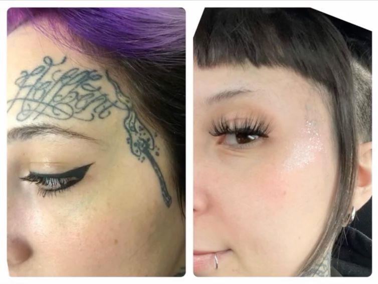 Women’s Face Tattoo Removal